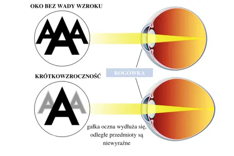 Ilustracja porównująca oko zdrowe z krótkowzrocznym, pokazująca skupienie światła.