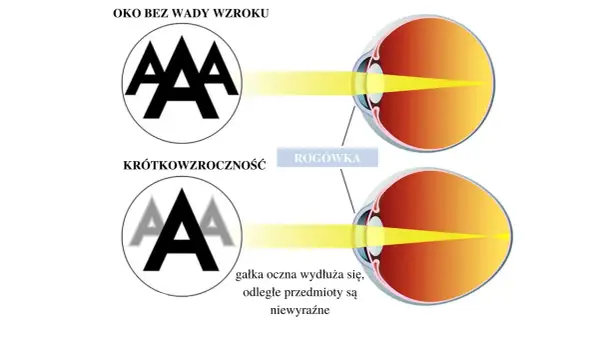 Ilustracja porównująca oko zdrowe z krótkowzrocznym, pokazująca skupienie światła.